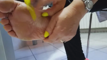prurito ai piedi.webp