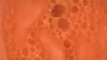 FullScreen exploration with pillcam from the doctor to the beauty center 720MP4.webp