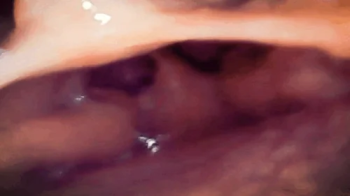 A Journey into the Depths- Exploring My Gut with PillCam, Through Sounds and Images of a Hidden World 720HD.webp